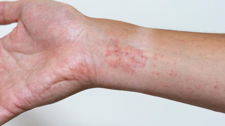 3. díl: Jak se zbavit ekzému? Vyzkoušejte naše 4 ověřené kroky